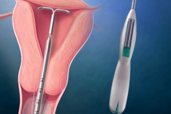 Cấy que tránh thai - tưởng không đau, hóa ra vẫn đau không tưởng-8