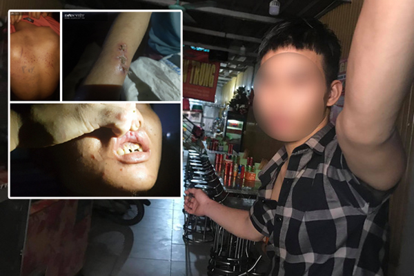 Kinh hoàng lời kể nạn nhân 15 tuổi bị chủ quán bánh xèo tra tấn: Bị đánh đập nhiều lần bằng chày đập đá và cạo vảy cá khiến cơ thể thương tích nặng nề, tinh thần hoảng loạn-8