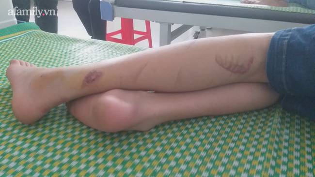 Kinh hoàng lời kể nạn nhân 15 tuổi bị chủ quán bánh xèo tra tấn: Bị đánh đập nhiều lần bằng chày đập đá và cạo vảy cá khiến cơ thể thương tích nặng nề, tinh thần hoảng loạn-3