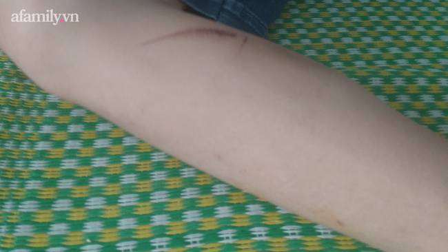 Kinh hoàng lời kể nạn nhân 15 tuổi bị chủ quán bánh xèo tra tấn: Bị đánh đập nhiều lần bằng chày đập đá và cạo vảy cá khiến cơ thể thương tích nặng nề, tinh thần hoảng loạn-4