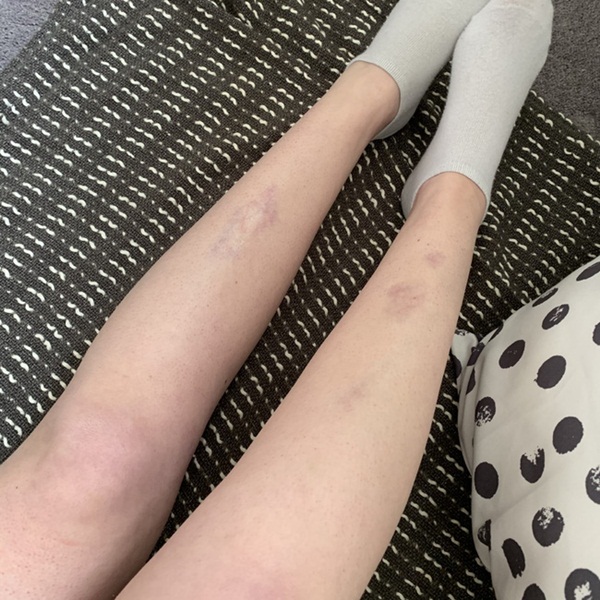 Bệnh tiểu đường đang âm thầm phát triển nếu bạn có một trong 6 dấu hiệu này trên da: Đa phần hệt như viêm da khiến nhiều người chủ quan-1