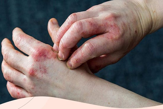 Bệnh tiểu đường đang âm thầm phát triển nếu bạn có một trong 6 dấu hiệu này trên da: Đa phần hệt như viêm da khiến nhiều người chủ quan