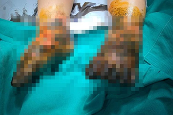 Bé trai bị nhiễm trùng nặng hai chân vì đắp thuốc nam-1