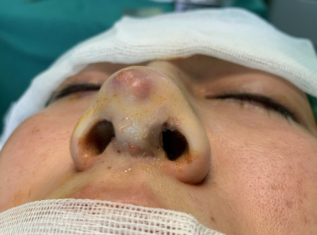 Thủng mũi, hoại tử mông sau khi làm đẹp tại spa-1