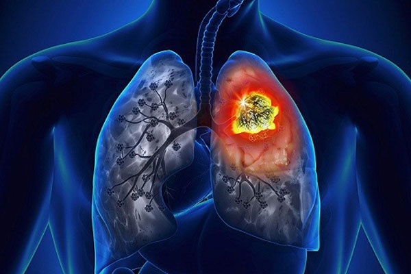 Cảnh báo 5 dấu hiệu không ngờ đến của ung thư phổi-1