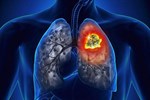 Người đàn ông mắc ung thư phổi sau 5 năm đi làm: Cảnh báo 6 việc dễ kích thích tế bào ung thư phát triển nhanh-6