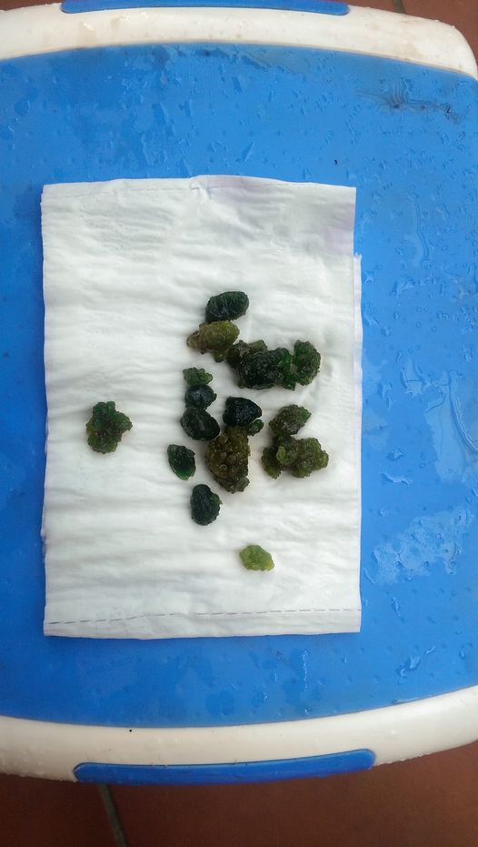 Xổ ra cả đống sỏi gan, sỏi mật nhờ uống dầu ôliu, dầu dừa: Sự thật kinh hoàng phía sau mới là điều bạn cần biết về trào lưu detox đang làm mưa gió trên MXH-3