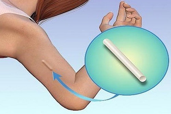 Cấy que tránh thai - tưởng không đau, hóa ra vẫn đau không tưởng-1