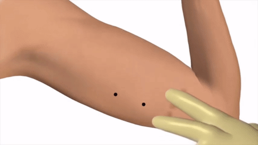 Cấy que tránh thai - tưởng không đau, hóa ra vẫn đau không tưởng-3