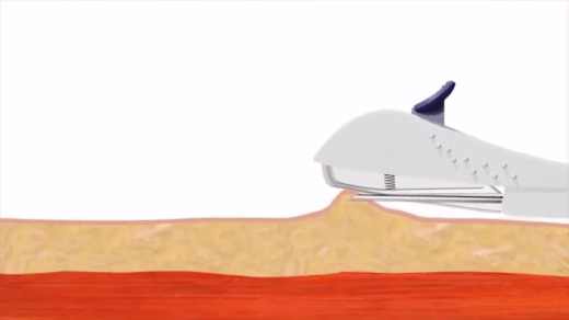 Cấy que tránh thai - tưởng không đau, hóa ra vẫn đau không tưởng-4