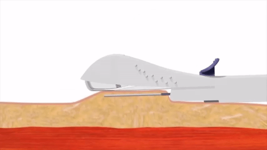 Cấy que tránh thai - tưởng không đau, hóa ra vẫn đau không tưởng-6