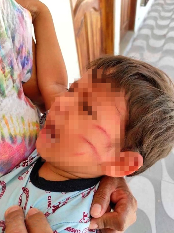 Để con trai 2 tuổi ở nhà với chị gái, bố mẹ trở về và chết lặng với vết thương chằng chịt trên thân thể con chỉ bởi nguyên do vô lý-1