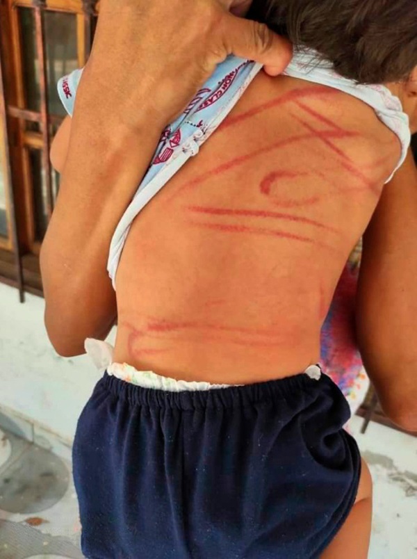 Để con trai 2 tuổi ở nhà với chị gái, bố mẹ trở về và chết lặng với vết thương chằng chịt trên thân thể con chỉ bởi nguyên do vô lý-2