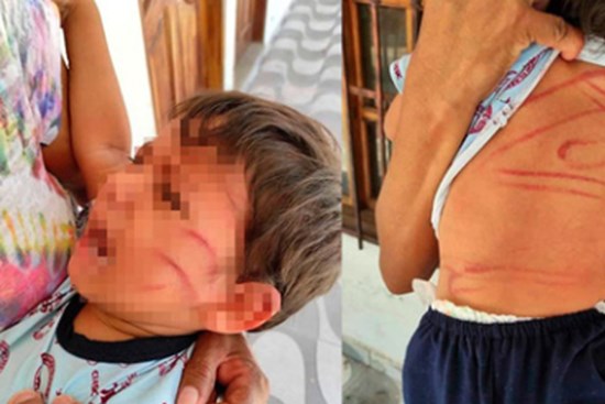 Để con trai 2 tuổi ở nhà với chị gái, bố mẹ trở về và chết lặng với vết thương chằng chịt trên thân thể con chỉ bởi nguyên do vô lý