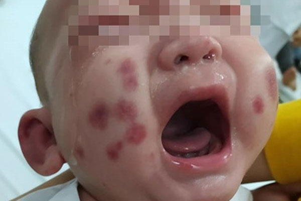 Bé trai mắc bệnh hiếm, lần đầu ghi nhận ở Việt Nam-1