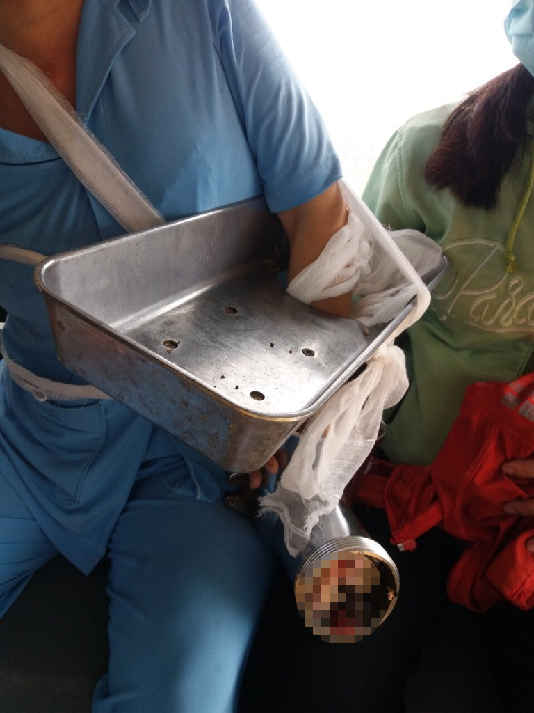 Vệ sinh máy xay thịt, người phụ nữ bị nghiền nát bàn tay-1