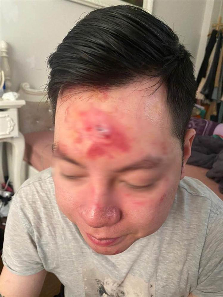 Hà Nội: Cãi vã vì mời rượu mà khách không uống, nhân viên quán bar xông vào đánh khách rách trán-2