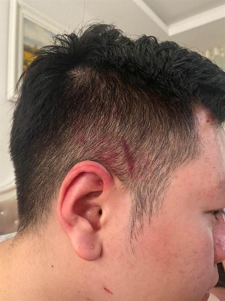 Hà Nội: Cãi vã vì mời rượu mà khách không uống, nhân viên quán bar xông vào đánh khách rách trán-3