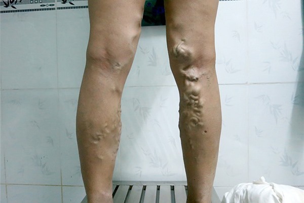 Mặc quần chật, đi giày cao gót: Thói quen gây ra căn bệnh chết người ở phụ nữ-1