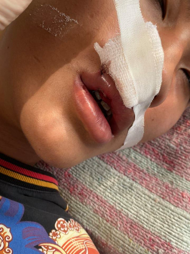 Hà Nội: Xác minh vụ việc nam sinh bị nhóm bạn đánh gãy răng, nhập viện khâu 7 mũi-2