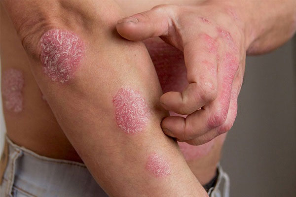 Sau khi bị người yêu đá, nam thanh niên bong vảy trắng khắp người-1