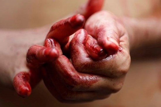 Người đầu tiên ở Việt Nam bị 'đổ mồ hôi máu' được chữa khỏi