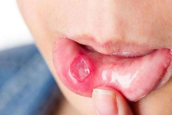 Ông bố trẻ qua đời ở tuổi 37 sau khi bị một vết loét ở miệng mãi không khỏi