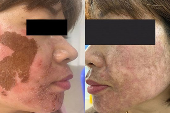 Trị nám da không đúng cách, nhiều chị em phải trả giá bằng... cả khuôn mặt