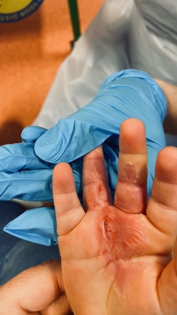 Mẹ vừa quay lưng đi thì nghe tiếng con hét thất thanh, hóa ra cả bàn tay bé bị nuốt chửng bởi món đồ nhà nào cũng có-4