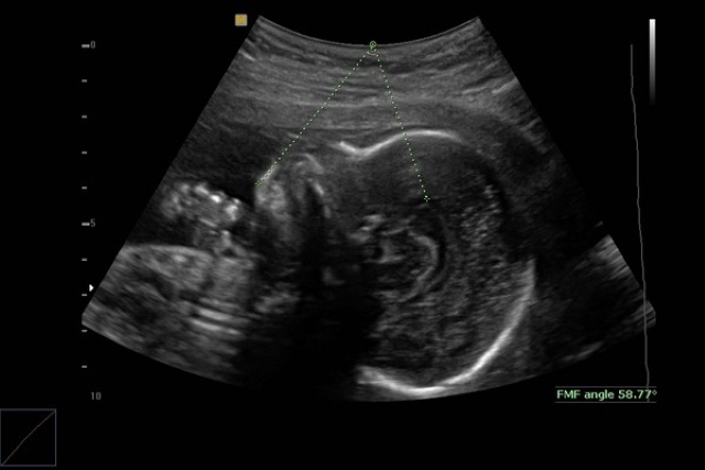 Thai phụ mắc bệnh ung thư khi mang thai con đầu lòng, nhà chồng kiên quyết giữ thai, bác sĩ tiết lộ kết quả đau lòng-2