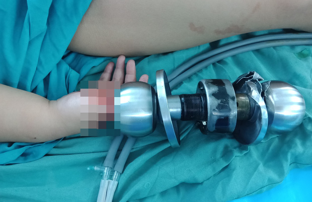 Bé trai 3 tuổi bị kẹt tay vào ổ khóa phải nhập viện, bác sĩ nhi đồng liền đưa lời khuyên cho các bậc phụ huynh-1