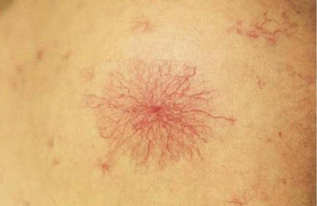 Tiền ung thư gan không đau, xuất hiện 1 ngứa, 2 hôi và 2 đỏ cần đi khám gan ngay-3