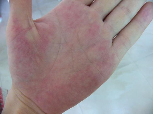 Tiền ung thư gan không đau, xuất hiện 1 ngứa, 2 hôi và 2 đỏ cần đi khám gan ngay-4