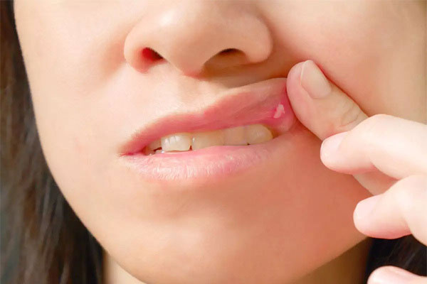 Vết loét miệng hay bị bỏ qua có thể là dấu hiệu của ung thư-1