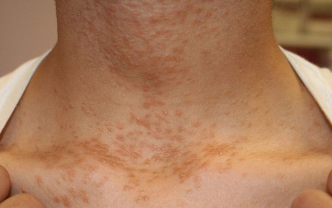 Cảnh giác, 4 dấu hiệu này ở cổ cho thấy tế bào ung thư đã xuất hiện trong cơ thể-4