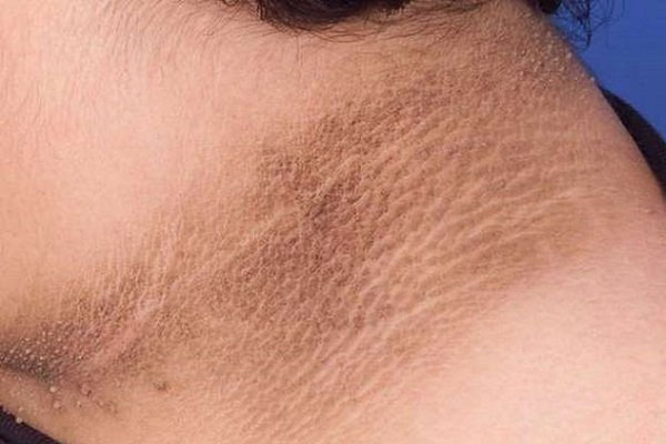 Cô gái 28 tuổi nửa đêm phải đến viện cấp cứu, bị liệt nửa người do phạm phải một sai lầm nguy hiểm trước khi đi ngủ-3
