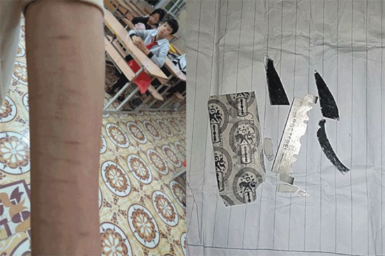 Cảnh báo: Xôn xao tình trạng nhiều học sinh dùng dao lam tự rạch tay chân, có em rạch đến 27 vết, nghi học theo trên Youtube