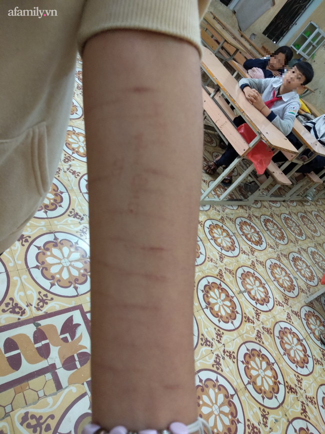 Cảnh báo: Xôn xao tình trạng nhiều học sinh dùng dao lam tự rạch tay chân, có em rạch đến 27 vết, nghi học theo trên Youtube-1