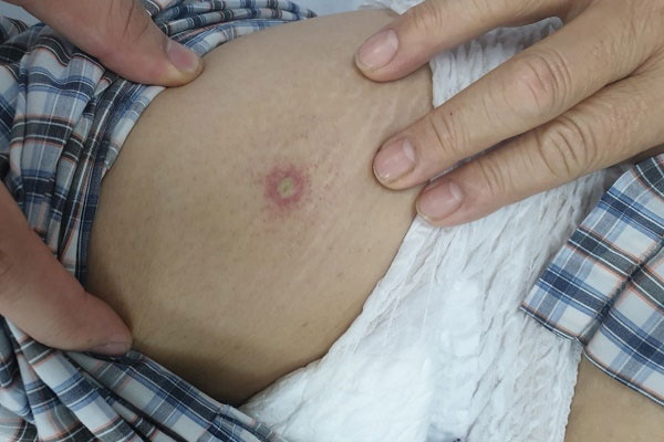 Cụ bà tại Trà Vinh bị ong đốt khiến suy gan, thận-2