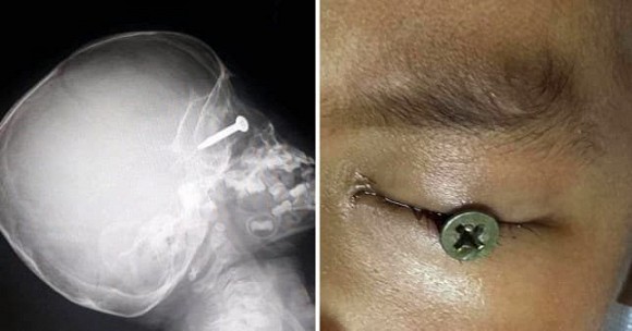Cậu bé 3 tuổi suýt bị mù sau khi đinh vít đâm vào mắt-1