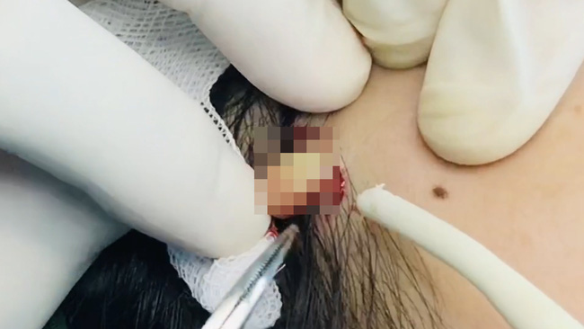 Từ vụ dịch mủ tuôn trào khi nạo vét filler vùng thái dương, chuyên gia cảnh tỉnh điều quan trọng khi độn thái dương-1