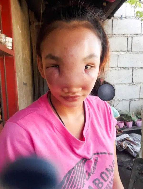 Thiếu nữ 17 tuổi bị biến dạng khuôn mặt sắp mù chỉ vì một hành động vô tư nhiều người vẫn làm, dáng vẻ trước khi gặp họa càng gây xót xa-1