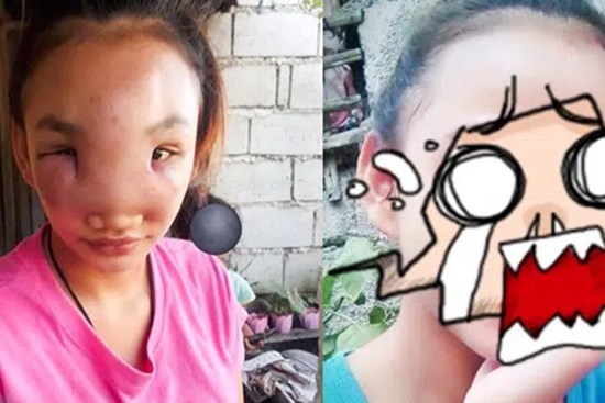 Thiếu nữ 17 tuổi bị biến dạng khuôn mặt sắp mù chỉ vì một hành động vô tư nhiều người vẫn làm, dáng vẻ trước khi gặp họa càng gây xót xa
