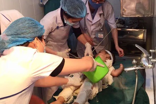 Bé 31 tháng tuổi nhiễm trùng nặng do chữa bỏng bằng... nước mắm và rượu