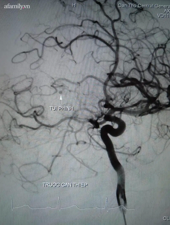 Bất ngờ nhức đầu và hôn mê, chàng trai mới 27 tuổi đã bị vỡ túi phình, xuất huyết não nguy kịch-1