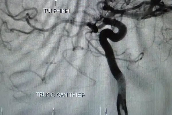 Người phụ nữ 45 tuổi qua đời vì xuất huyết não, nguyên nhân là do ăn nhiều loại thực phẩm khiến máu đặc như cháo-4