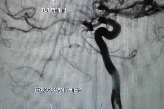 Bất ngờ nhức đầu và hôn mê, chàng trai mới 27 tuổi đã bị vỡ túi phình, xuất huyết não nguy kịch