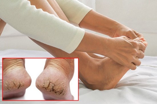5 'bí kíp' giúp chân không bị nứt toác khô tróc mùa Thu Đông