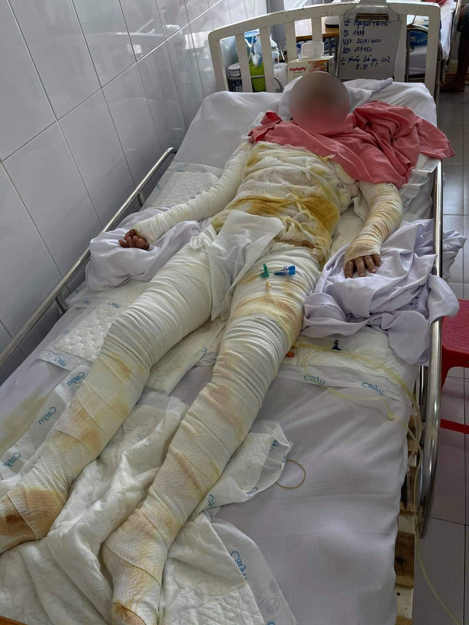 Bạn trai qua đời, cô gái bỏng 73% do nổ bình gas: Hà đợi năm sau làm ăn có tiền, tụi nó mới cưới nhau-4