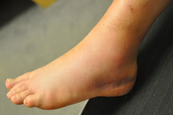 Cô gái 27 tuổi mắc ung thư vì loại chất độc hạng nhất mà WHO cảnh báo, có trong thực phẩm mà dù nấu chín cũng không thể tiêu diệt-5